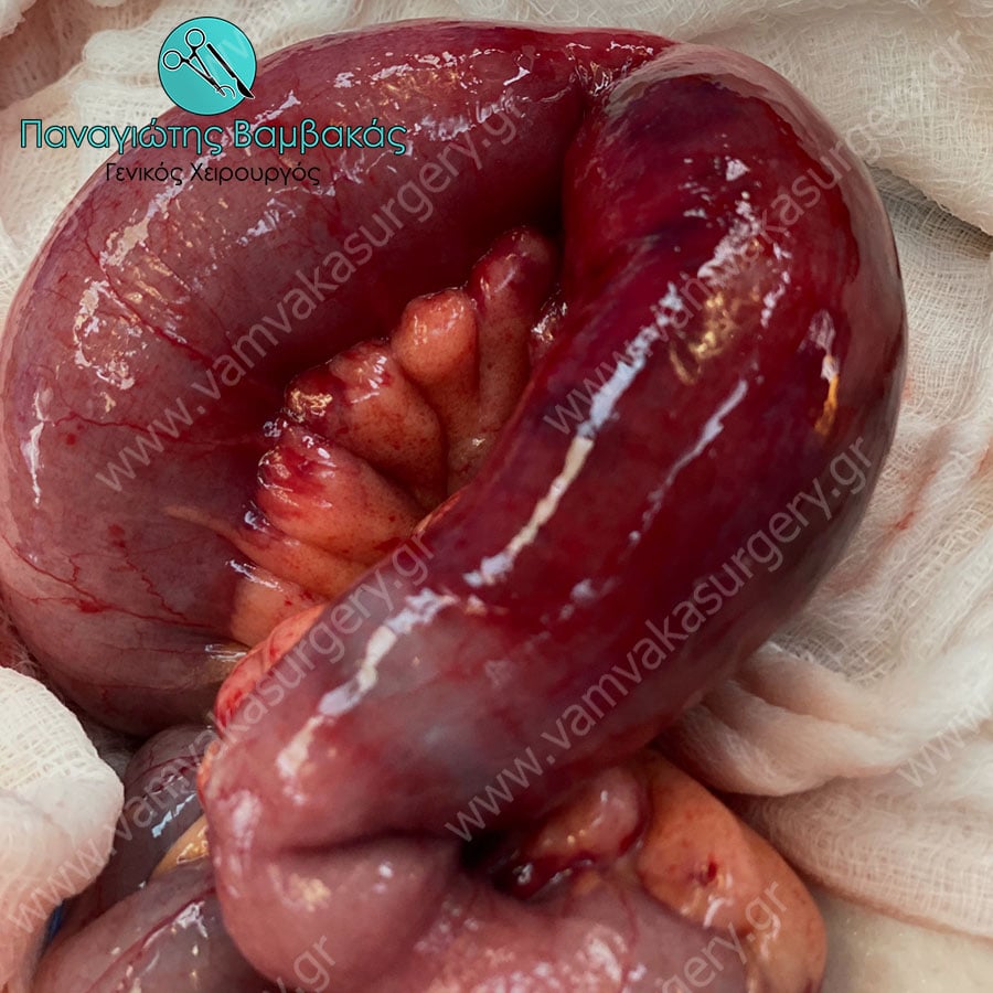 Αποφρακτικός ειλεός