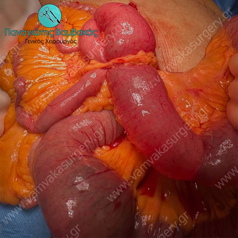 Απόφραξη πεπτικού λόγω συμφύσεων - αποφρακτικός ειλεός