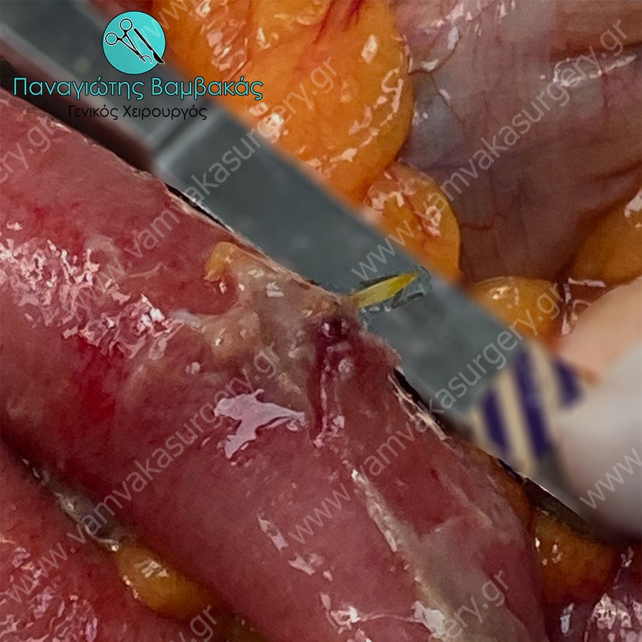 Διάτρηση από ψαροκόκαλο