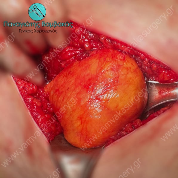 Γιγαντιαίος όγκος γλουτού