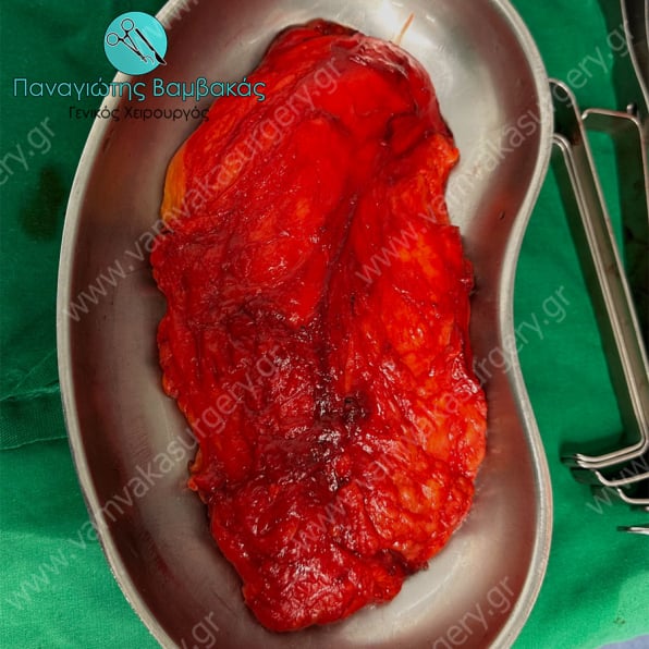 Γιγαντιαίος όγκος γλουτού