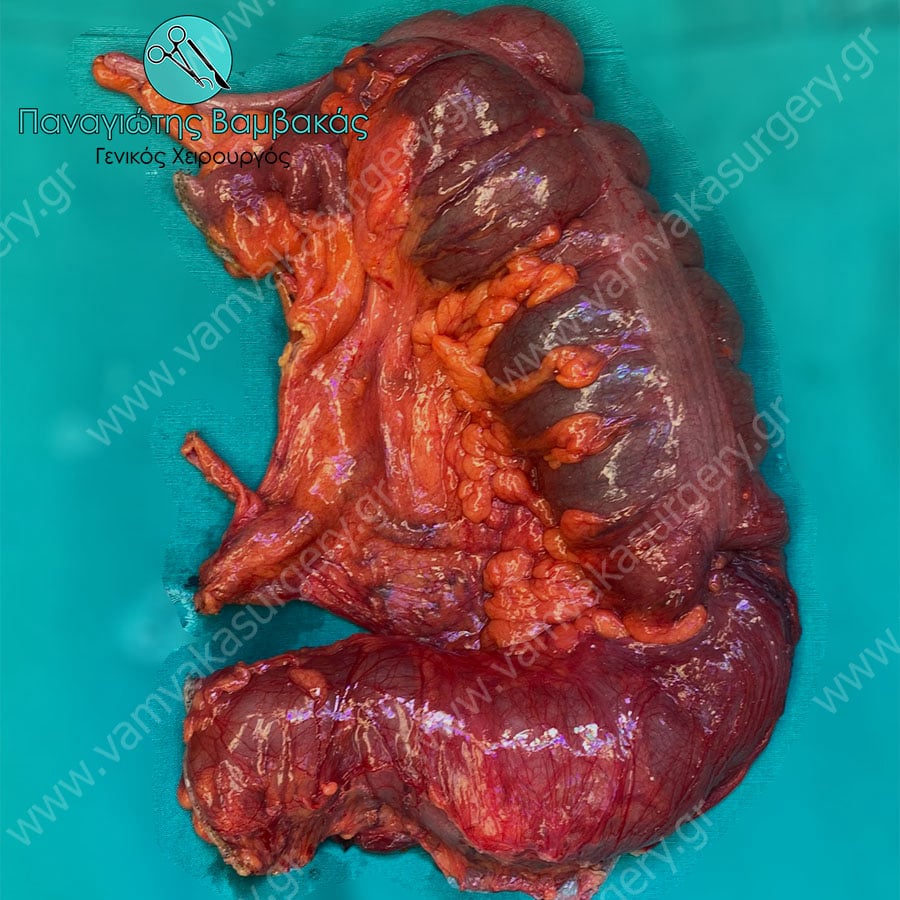 Καρκίνος εντέρου