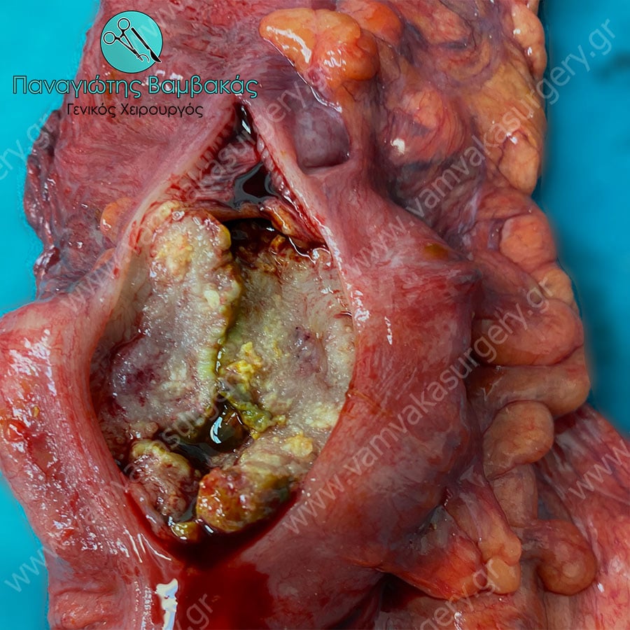 Καρκίνος εντέρου