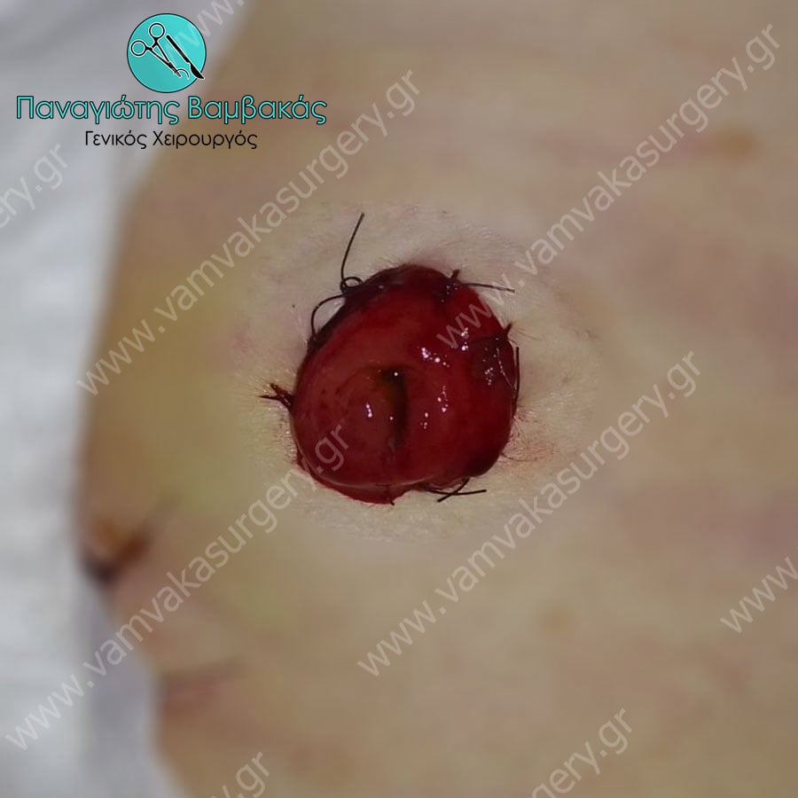 Κολοστομία