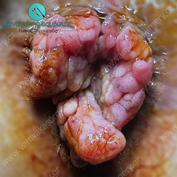 Κονδυλώματα