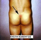 Κύστη κόκκυγος