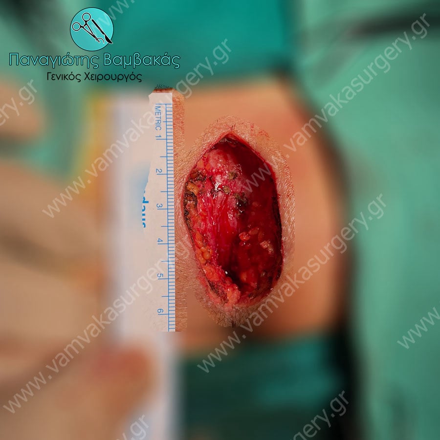 Θυρεοειδεκτομή