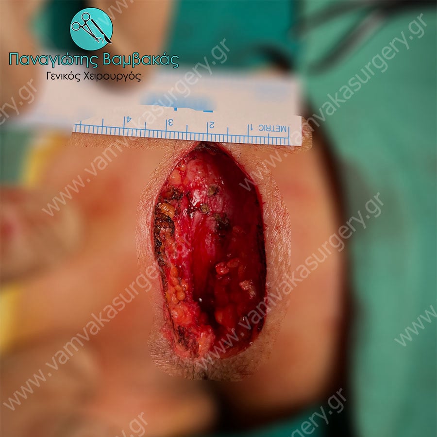 Θυρεοειδεκτομή