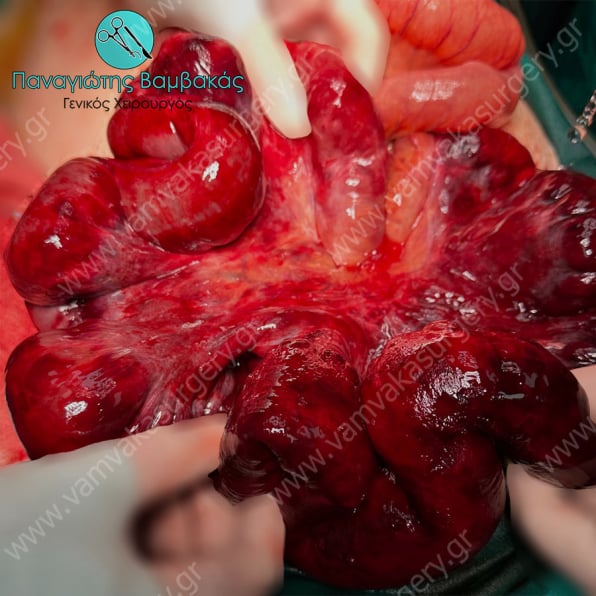 Νέκρωση εντέρου