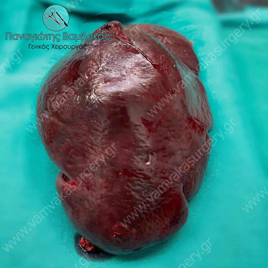 Όγκος σπληνός