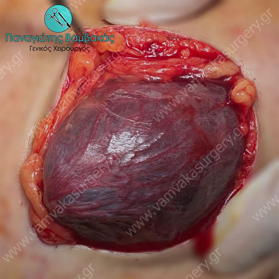 Περιεσφιγμένη Βουβωνοκήλη