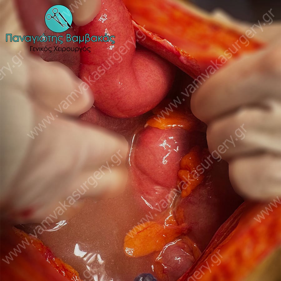 Περιτονίτιδα