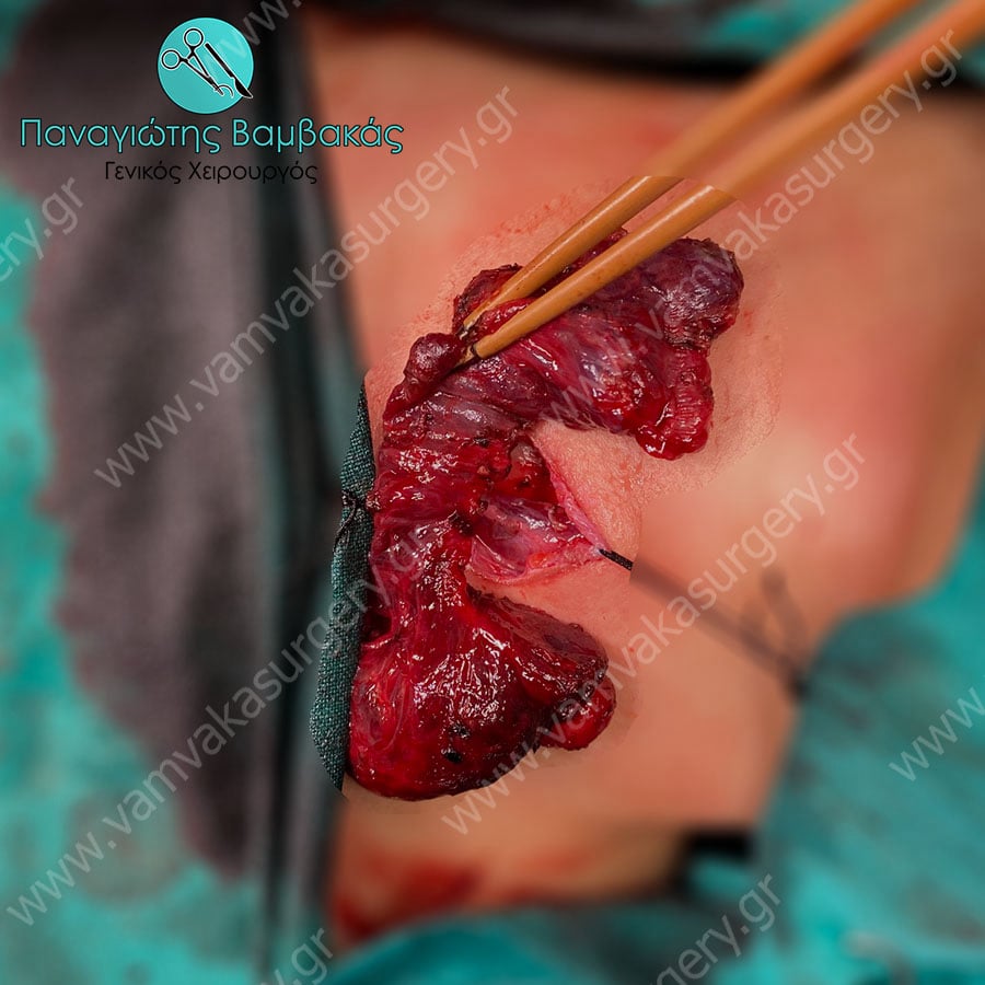 Θυρεοειδεκτομή