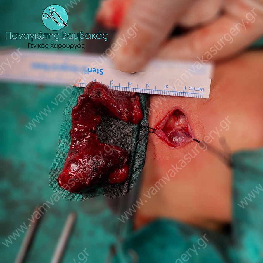 Θυρεοειδεκτομή