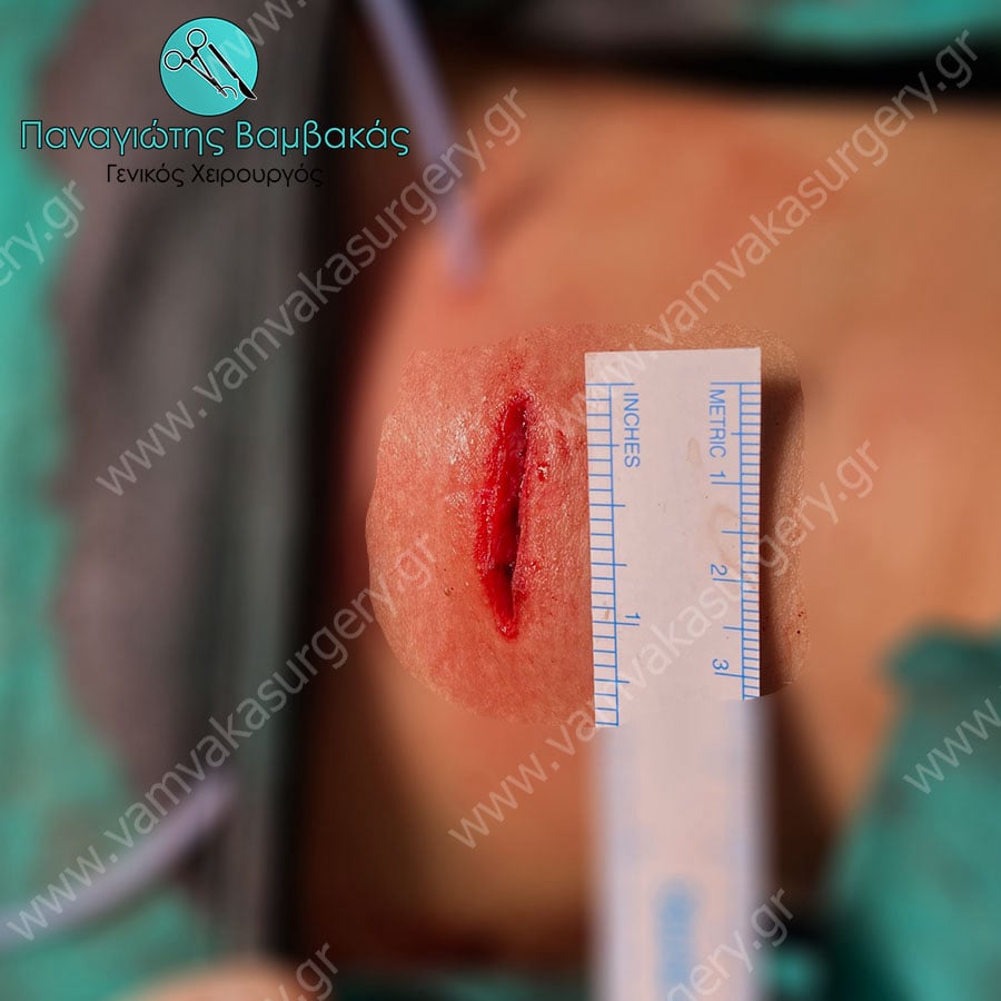 Θυρεοειδεκτομή