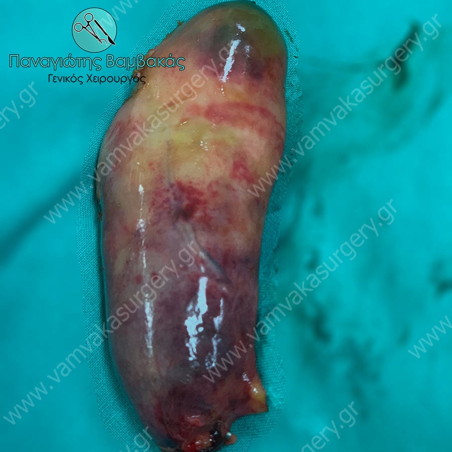 Χολοκυστεκτομή